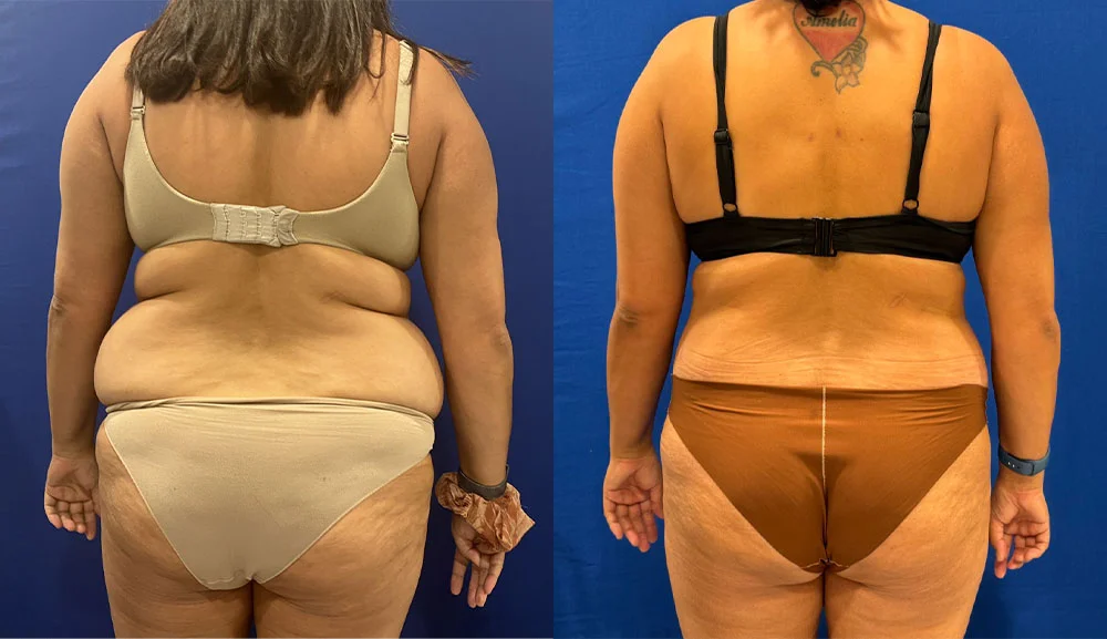 POST OP 360 ABDOMINOPLASTY BACK_