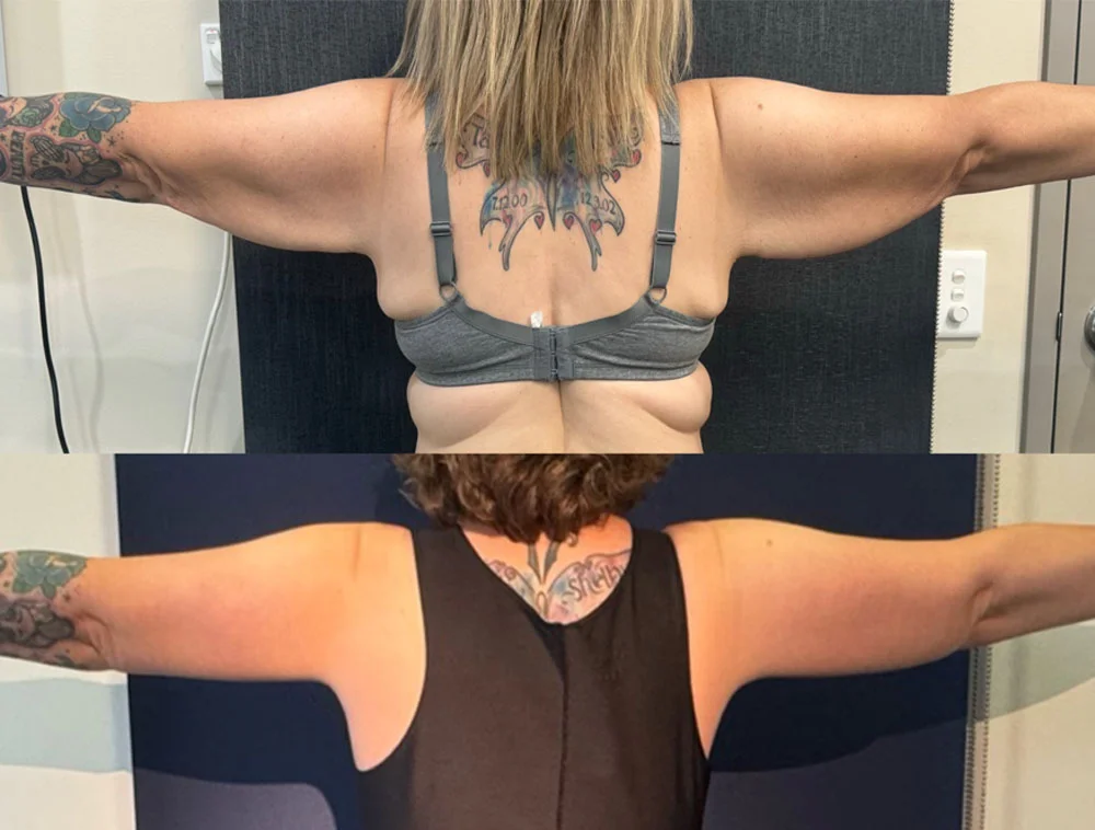 POST OP BRACHIOPLASTY BACK.PNG