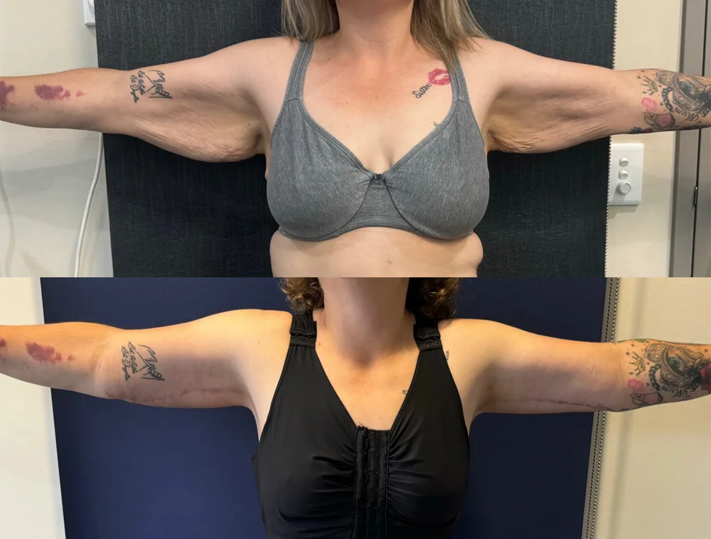 POST OP BRACHIOPLASTY FRONT.PNG