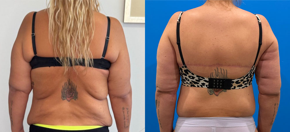 PRE OP CORSET ABDO FRONT