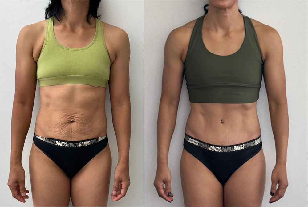 Real Patient Results in New South Wales, Australia Performed by Dr. Anthony Barker