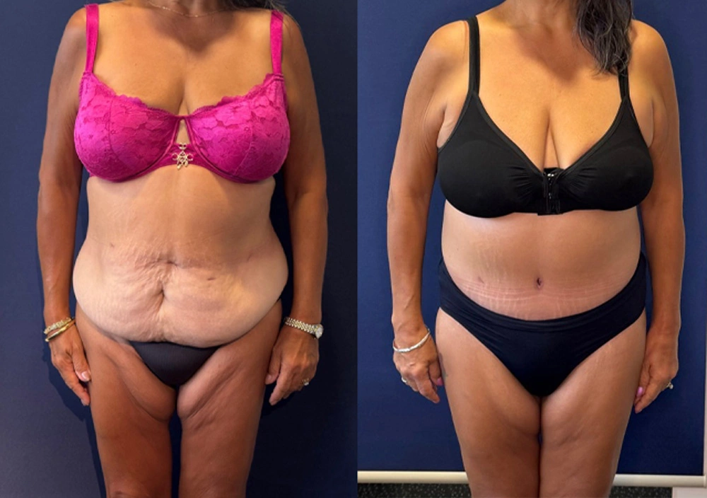 Real Patient Results in New South Wales, Australia Performed by Dr. Anthony Barker