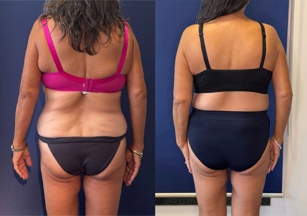 Real Patient Results in New South Wales, Australia Performed by Dr. Anthony Barker