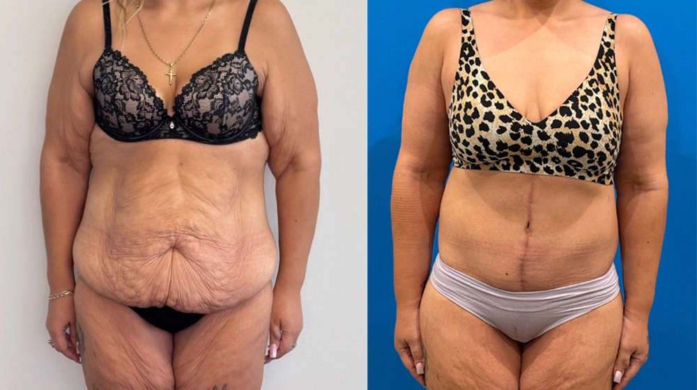 Real Patient Results in New South Wales, Australia Performed by Dr. Anthony Barker