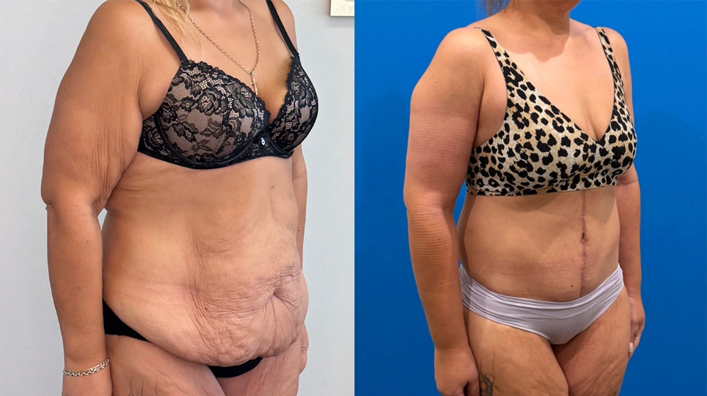 Real Patient Results in New South Wales, Australia Performed by Dr. Anthony Barker