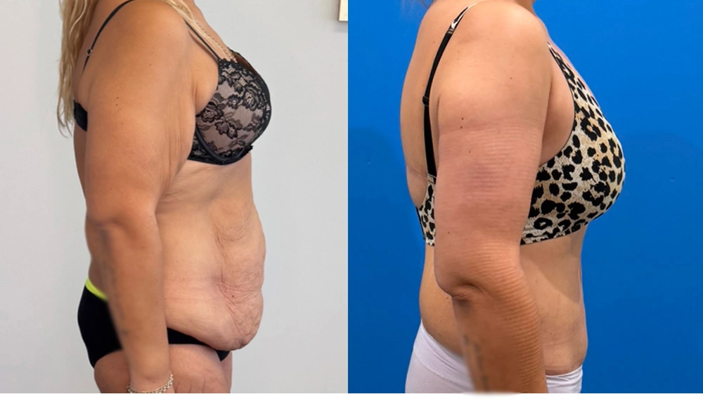 Real Patient Results in New South Wales, Australia Performed by Dr. Anthony Barker