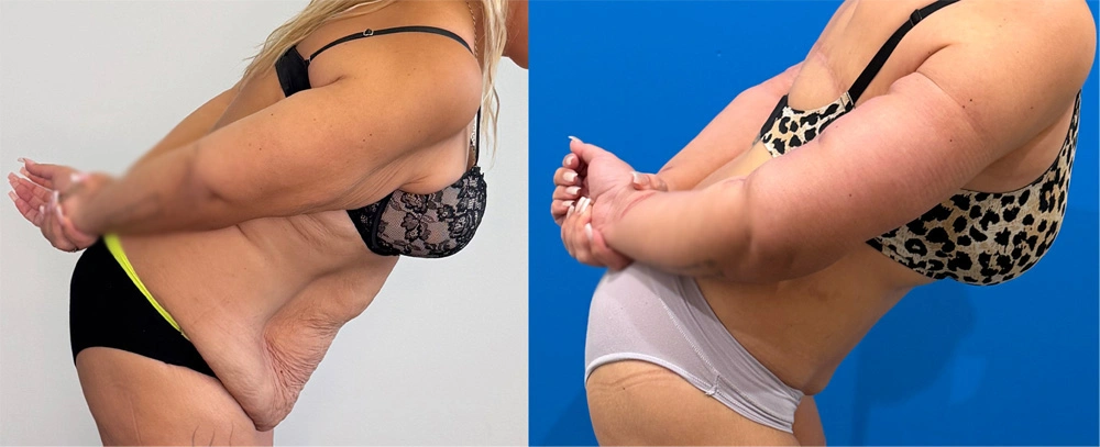 Real Patient Results in New South Wales, Australia Performed by Dr. Anthony Barker