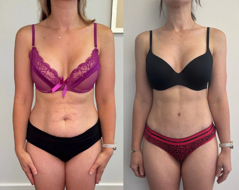 Real Patient Results in New South Wales, Australia Performed by Dr. Anthony Barker