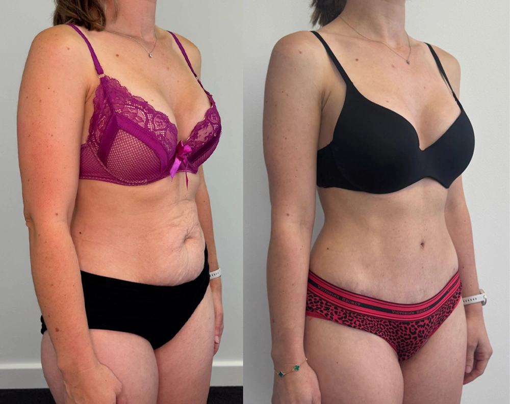 Real Patient Results in New South Wales, Australia Performed by Dr. Anthony Barker