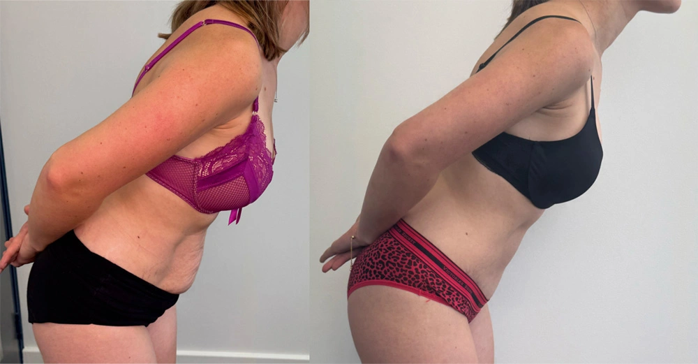 Real Patient Results in New South Wales, Australia Performed by Dr. Anthony Barker