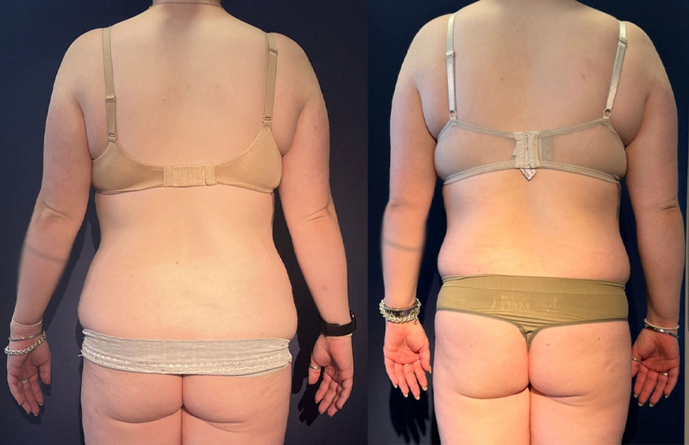 Real Patient Results in New South Wales, Australia Performed by Dr. Anthony Barker