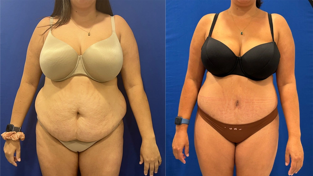 Real Patient Results in New South Wales, Australia Performed by Dr. Anthony Barker