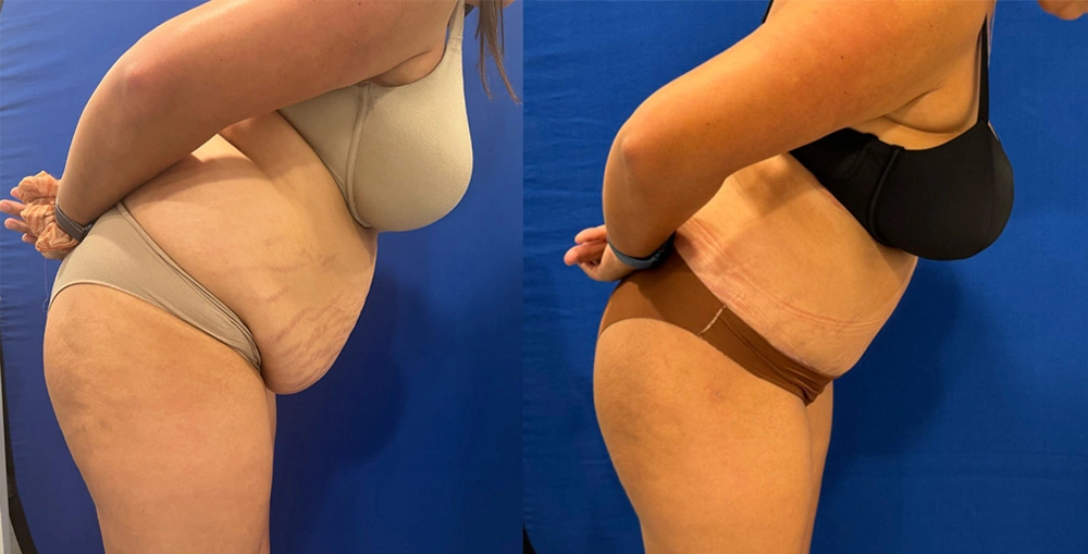 Real Patient Results in New South Wales, Australia Performed by Dr. Anthony Barker