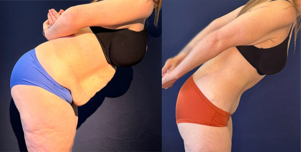 Real Patient Results in New South Wales, Australia Performed by Dr. Anthony Barker