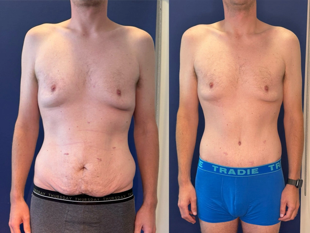 Real Patient Results in New South Wales, Australia Performed by Dr. Anthony Barker