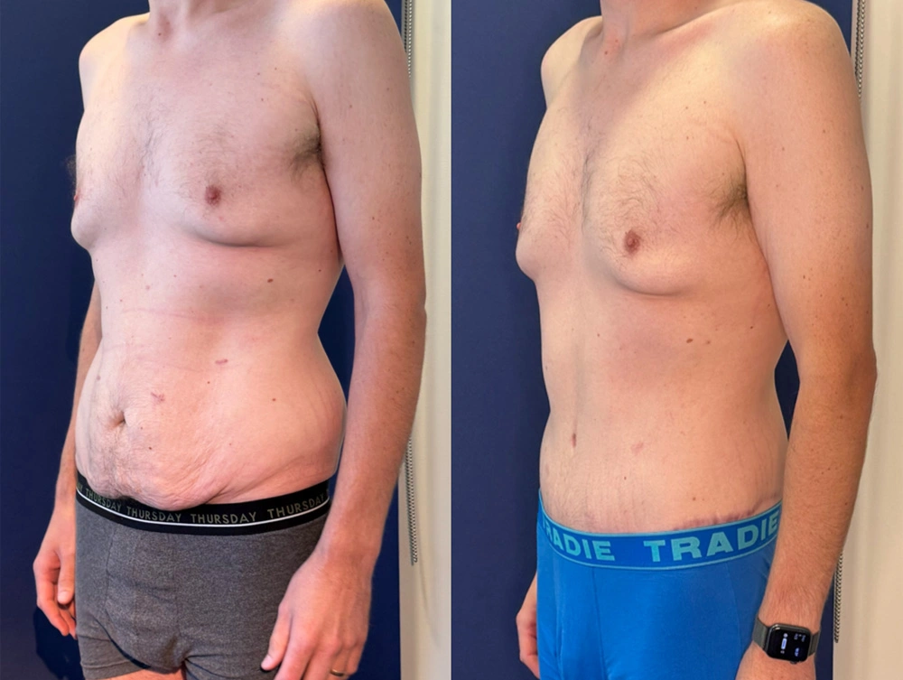 Real Patient Results in New South Wales, Australia Performed by Dr. Anthony Barker