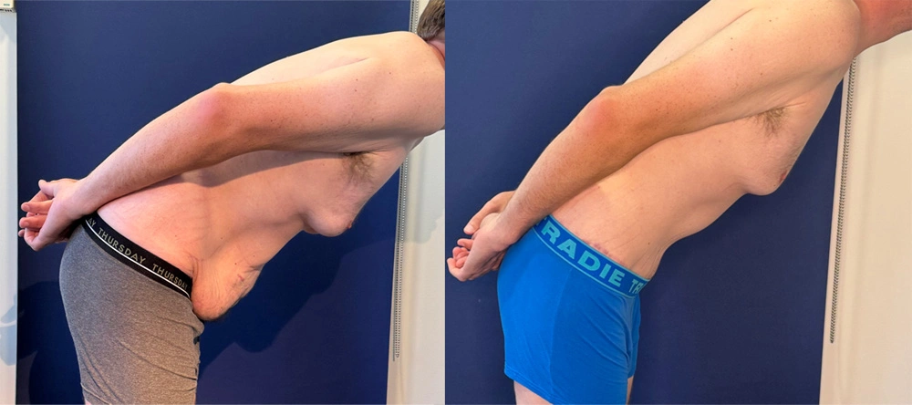 Real Patient Results in New South Wales, Australia Performed by Dr. Anthony Barker