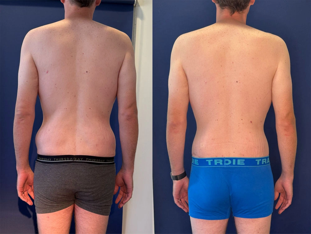Real Patient Results in New South Wales, Australia Performed by Dr. Anthony Barker