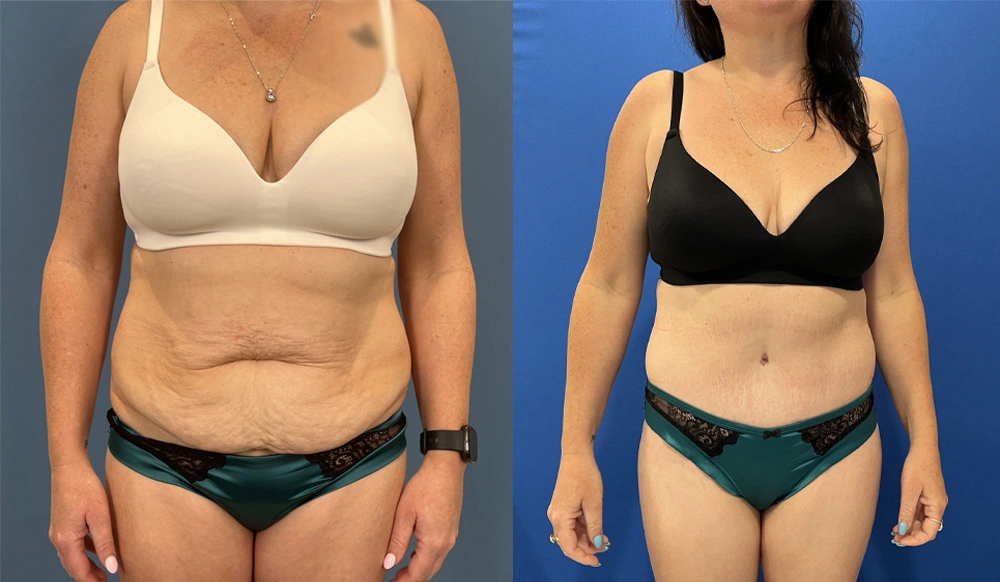 Real Patient Results in New South Wales, Australia Performed by Dr. Anthony Barker