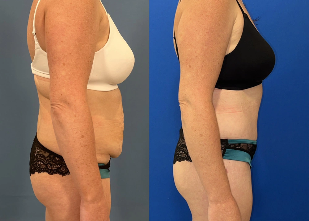 Real Patient Results in New South Wales, Australia Performed by Dr. Anthony Barker
