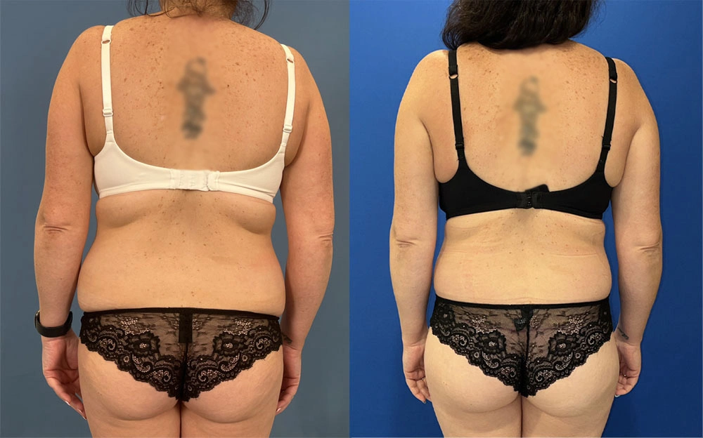 Real Patient Results in New South Wales, Australia Performed by Dr. Anthony Barker