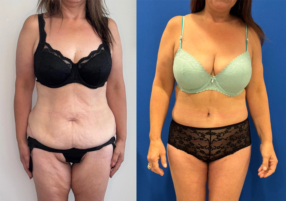 Real Patient Results in New South Wales, Australia Performed by Dr. Anthony Barker