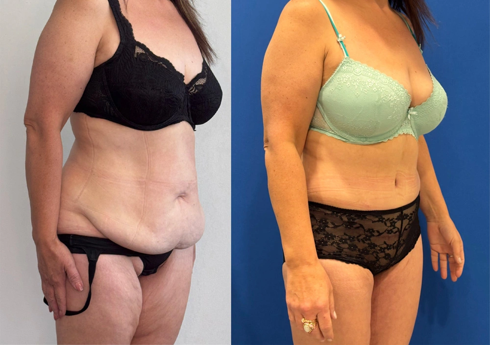 Real Patient Results in New South Wales, Australia Performed by Dr. Anthony Barker