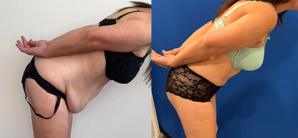 Real Patient Results in New South Wales, Australia Performed by Dr. Anthony Barker