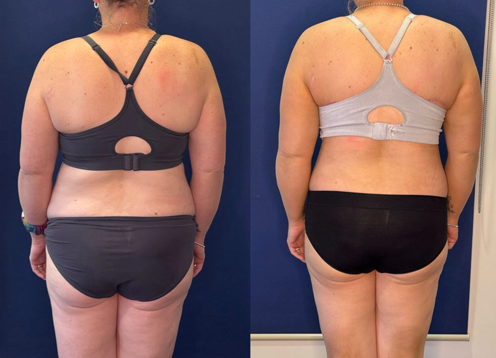 Real Patient Results in New South Wales, Australia Performed by Dr. Anthony Barker