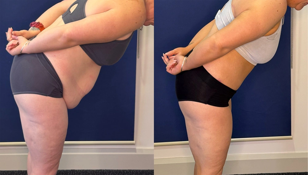 Real Patient Results in New South Wales, Australia Performed by Dr. Anthony Barker
