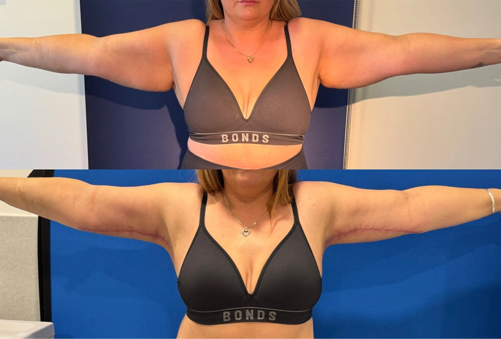 Real Patient Results in New South Wales, Australia Performed by Dr. Anthony Barker