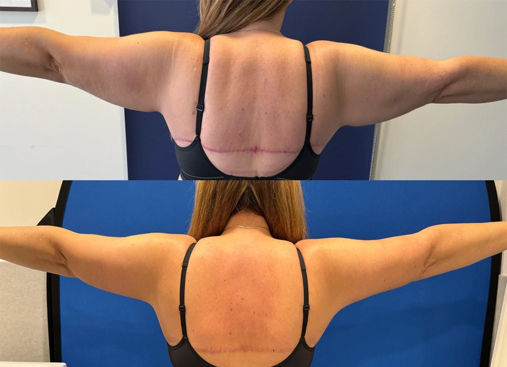 Real Patient Results in New South Wales, Australia Performed by Dr. Anthony Barker