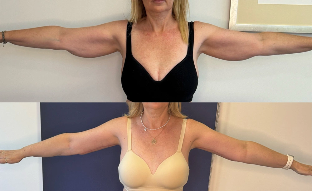 Real Patient Results in New South Wales, Australia Performed by Dr. Anthony Barker