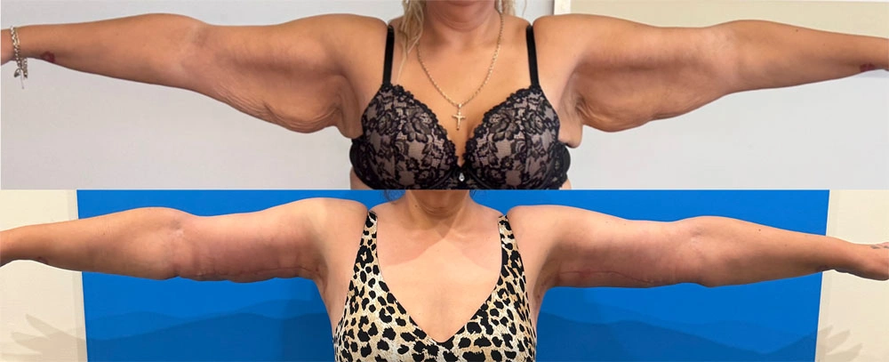 Real Patient Results in New South Wales, Australia Performed by Dr. Anthony Barker