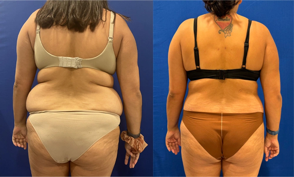 Real Patient Results in New South Wales, Australia Performed by Dr. Anthony Barker