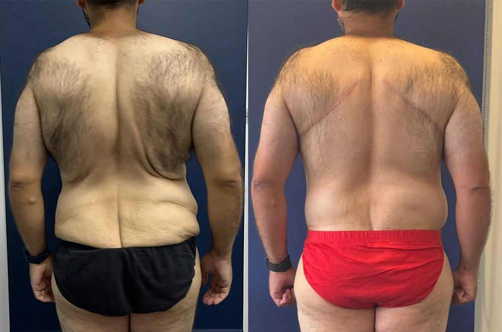 Real Patient Results in New South Wales, Australia Performed by Dr. Anthony Barker