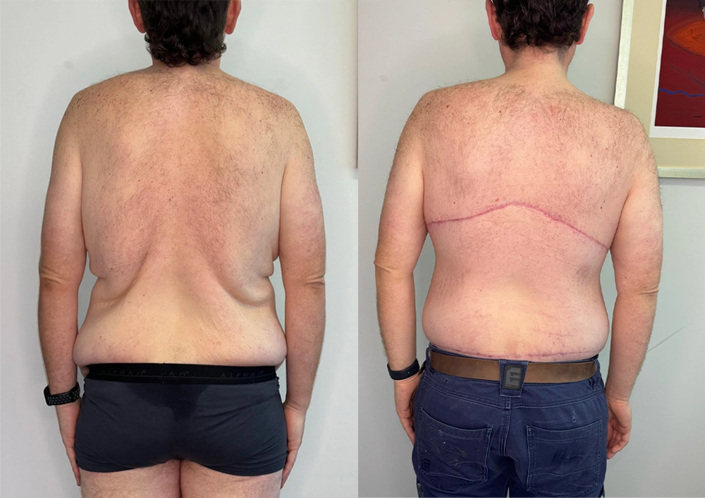 Real Patient Results in New South Wales, Australia Performed by Dr. Anthony Barker