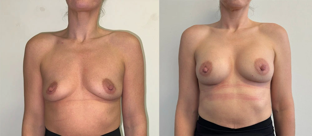 Real Patient Results in New South Wales, Australia Performed by Dr. Anthony Barker