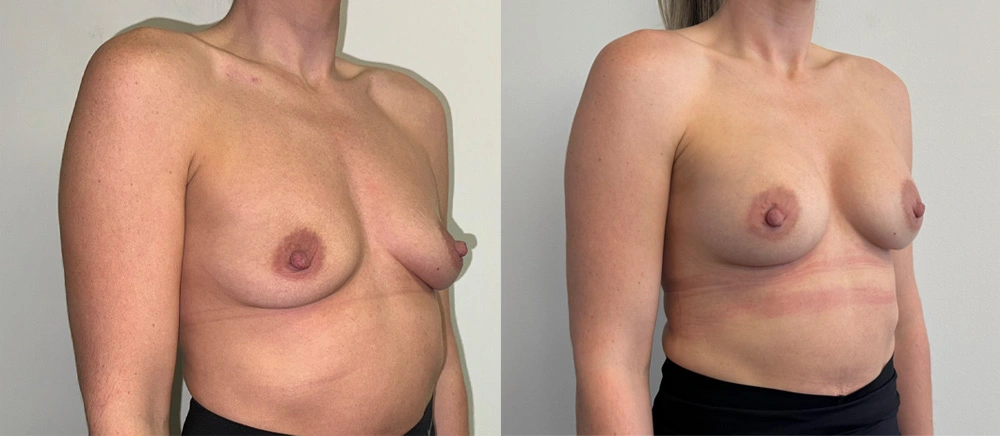 Real Patient Results in New South Wales, Australia Performed by Dr. Anthony Barker
