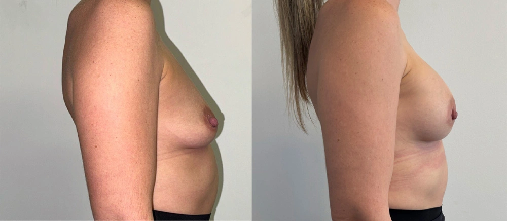 Real Patient Results in New South Wales, Australia Performed by Dr. Anthony Barker