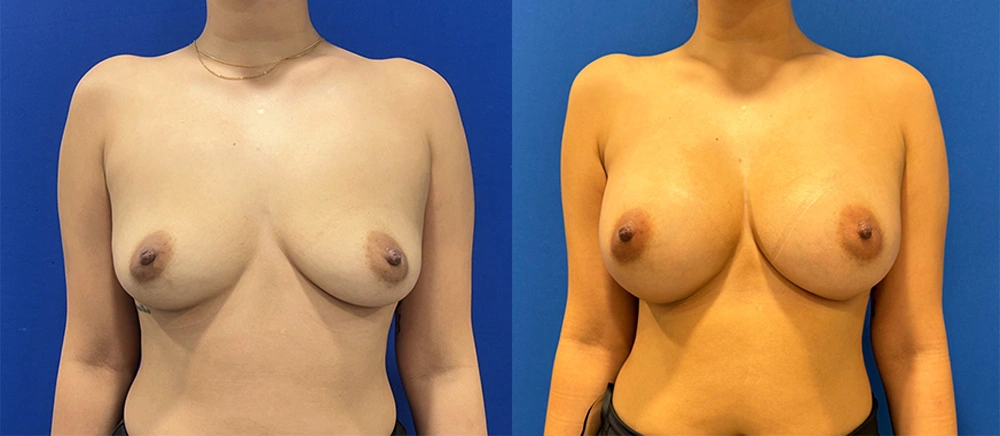 Real Patient Results in New South Wales, Australia Performed by Dr. Anthony Barker