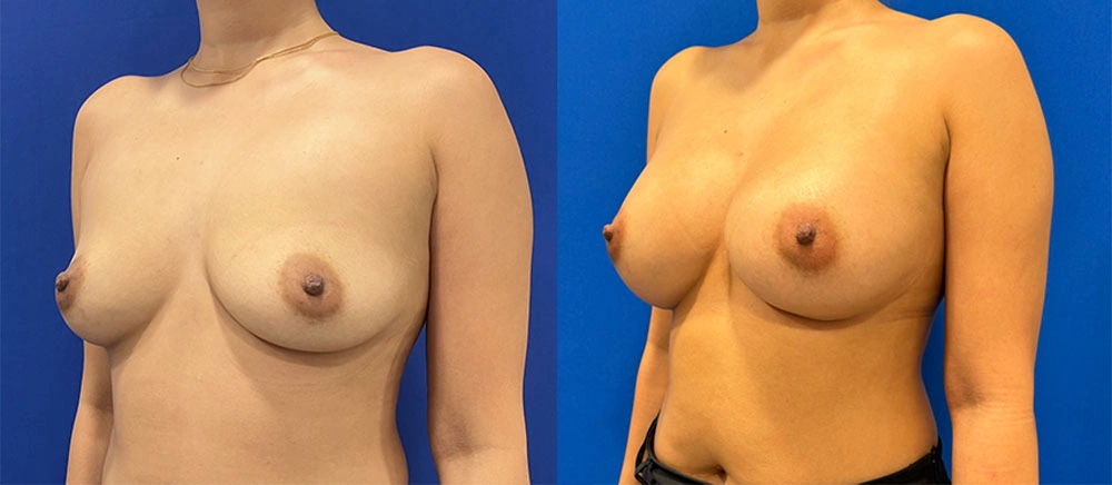 Real Patient Results in New South Wales, Australia Performed by Dr. Anthony Barker