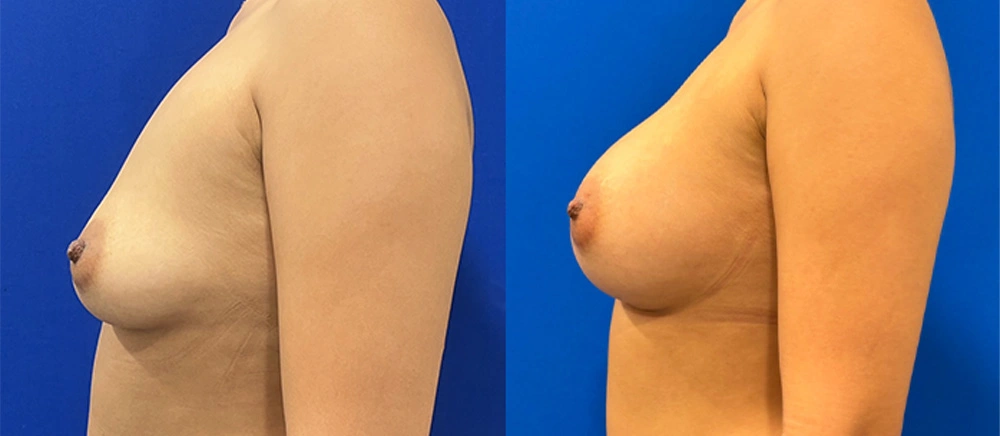 Real Patient Results in New South Wales, Australia Performed by Dr. Anthony Barker