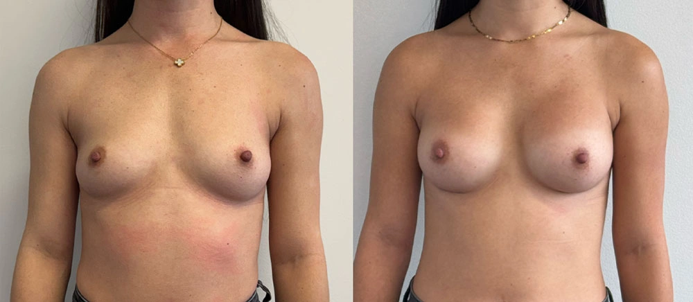 Real Patient Results in New South Wales, Australia Performed by Dr. Anthony Barker