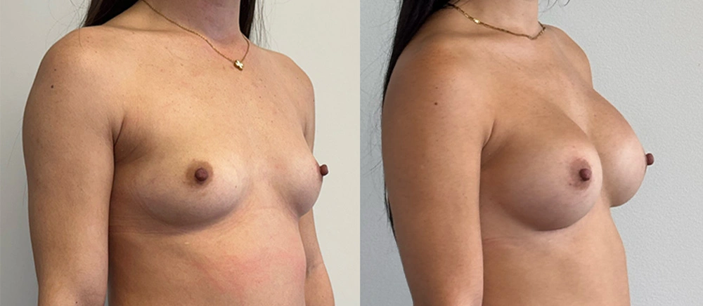 Real Patient Results in New South Wales, Australia Performed by Dr. Anthony Barker