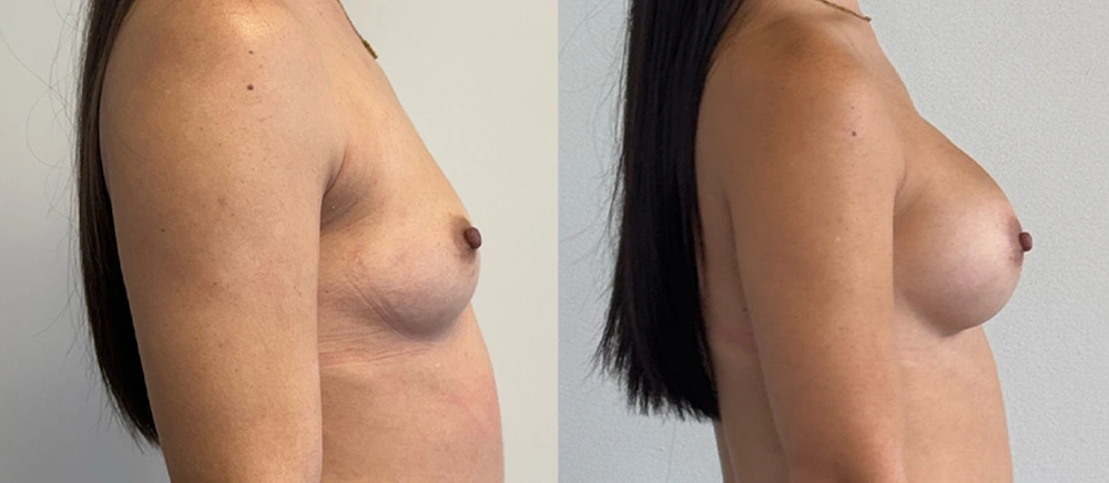 Real Patient Results in New South Wales, Australia Performed by Dr. Anthony Barker