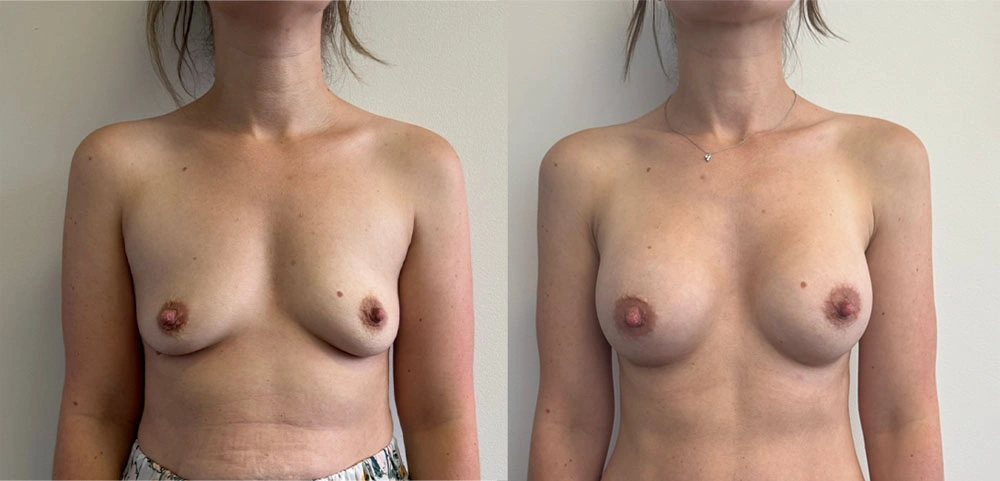 Real Patient Results in New South Wales, Australia Performed by Dr. Anthony Barker