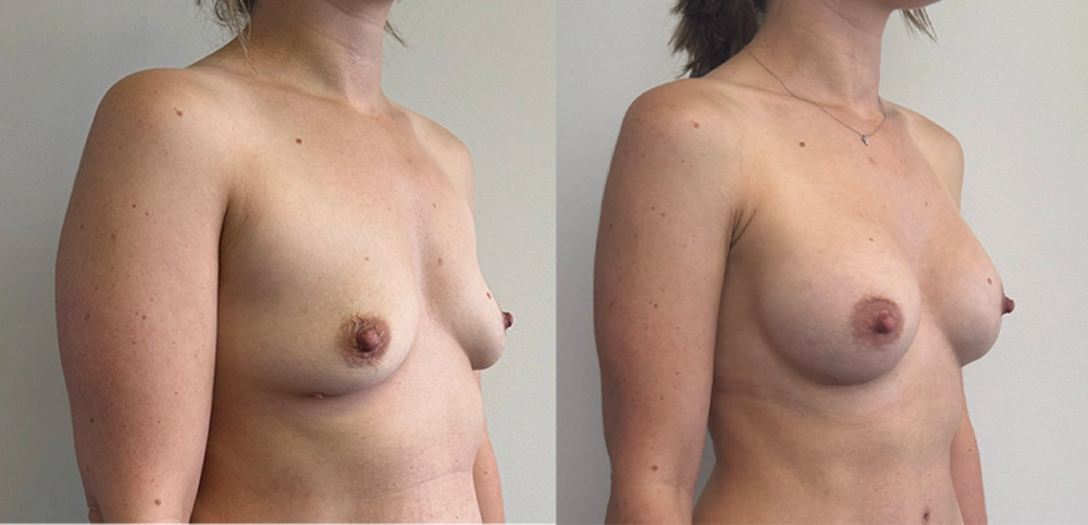 Real Patient Results in New South Wales, Australia Performed by Dr. Anthony Barker