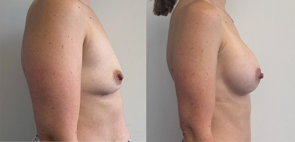 Real Patient Results in New South Wales, Australia Performed by Dr. Anthony Barker