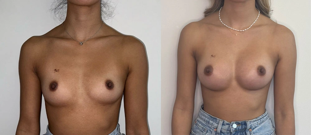 Real Patient Results in New South Wales, Australia Performed by Dr. Anthony Barker